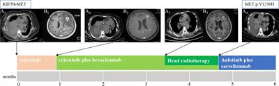 Case report: Acquired resistance to crizotinib from a MET Y1230H mutation in a patient with non-small cell lung cancer and KIF5B-MET fusion
